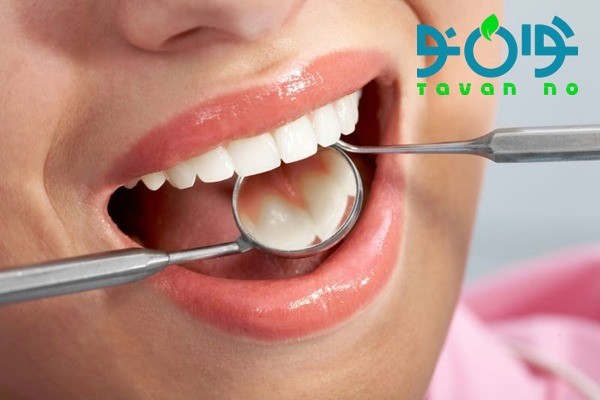 کامپوزیت ددان چیست؟